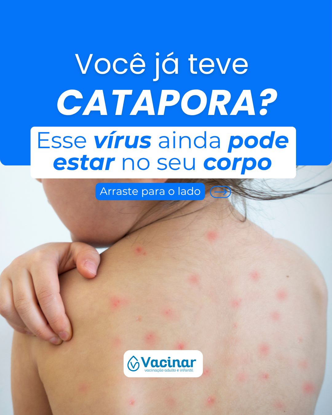 Herpes-zóster em quem teve catapora